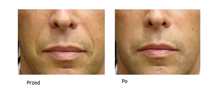 Pierwsze oznaki starzenia jak sobie pomóc?