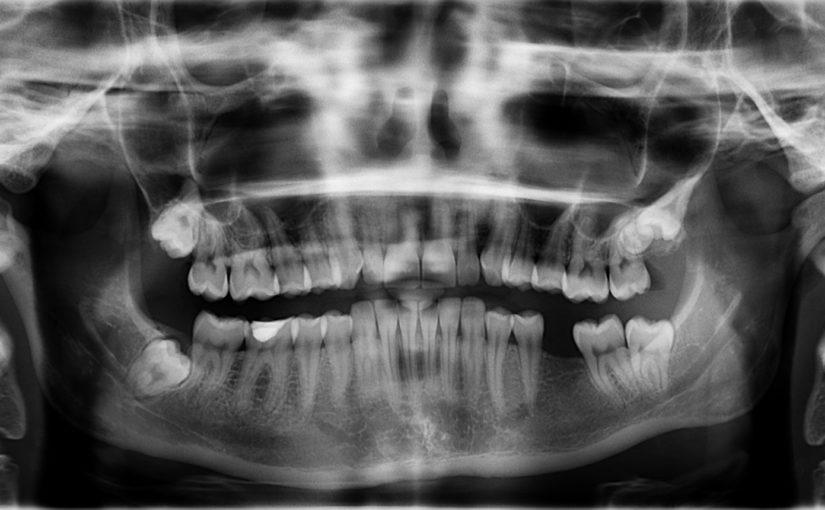 Złe postępowanie odżywiania się to większe niedobory w jamie ustnej oraz dodatkowo ich brak